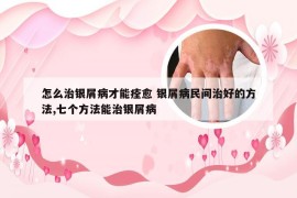 怎么治银屑病才能痊愈 银屑病民间治好的方法,七个方法能治银屑病