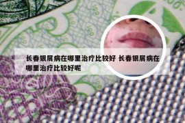 长春银屑病在哪里治疗比较好 长春银屑病在哪里治疗比较好呢