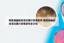 银屑病扁桃体发炎要打青霉素吗 银屑病扁桃体发炎要打青霉素吗多少钱