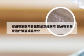 郑州哪家医院看银屑病正规医院 郑州哪家医院治疗银屑病最专业