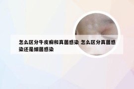 怎么区分牛皮癣和真菌感染 怎么区分真菌感染还是细菌感染