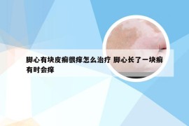 脚心有块皮癣很痒怎么治疗 脚心长了一块癣有时会痒