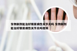 生物制剂能治好银屑病性关节炎吗 生物制剂能治好银屑病性关节炎吗视频