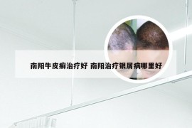 南阳牛皮癣治疗好 南阳治疗银屑病哪里好