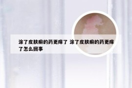 涂了皮肤癣的药更痒了 涂了皮肤癣的药更痒了怎么回事