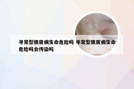 寻常型银屑病生命危险吗 寻常型银屑病生命危险吗会传染吗