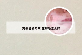 克癣皂的功效 克癣皂怎么样