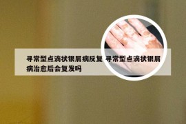 寻常型点滴状银屑病反复 寻常型点滴状银屑病治愈后会复发吗