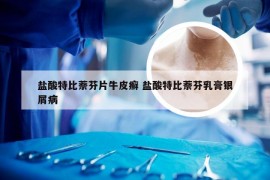 盐酸特比萘芬片牛皮癣 盐酸特比萘芬乳膏银屑病