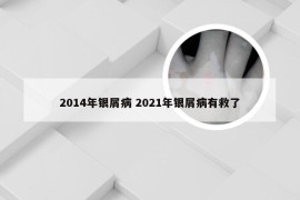 2014年银屑病 2021年银屑病有救了