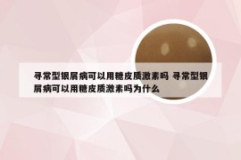 寻常型银屑病可以用糖皮质激素吗 寻常型银屑病可以用糖皮质激素吗为什么