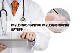 脖子上对称分布的白斑 脖子上出现对称的癣是咋回事