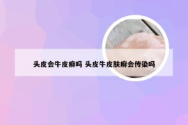 头皮会牛皮癣吗 头皮牛皮肤癣会传染吗