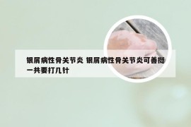 银屑病性骨关节炎 银屑病性骨关节炎可善挺一共要打几针