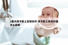 1最大孩子脸上出现白印 孩子脸上有白印是怎么回事