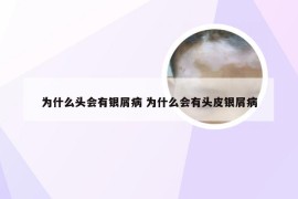 为什么头会有银屑病 为什么会有头皮银屑病