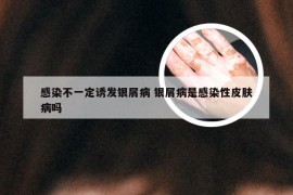 感染不一定诱发银屑病 银屑病是感染性皮肤病吗