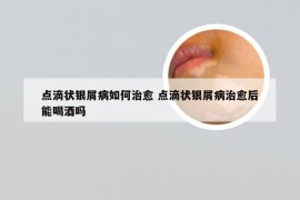 点滴状银屑病如何治愈 点滴状银屑病治愈后能喝酒吗