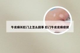 牛皮癣长肛门上怎么回事 肛门牛皮皮癣症状