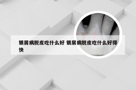 银屑病脱皮吃什么好 银屑病脱皮吃什么好得快