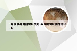 牛皮肤癣用醋可以洗吗 牛皮廨可以用醋擦拭吗