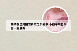 孩子嘴巴周围发白斑怎么回事 小孩子嘴巴周围一圈发白