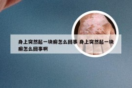 身上突然起一块癣怎么回事 身上突然起一块癣怎么回事啊