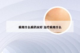 癣用什么癣药水好 治疗癣用什么