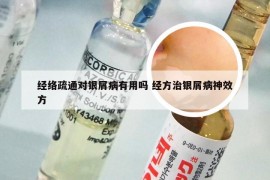 经络疏通对银屑病有用吗 经方治银屑病神效方