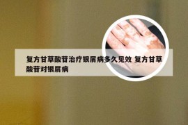 复方甘草酸苷治疗银屑病多久见效 复方甘草酸苷对银屑病