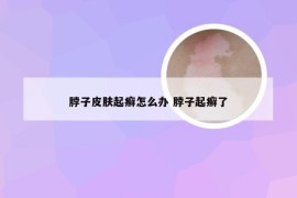 脖子皮肤起癣怎么办 脖子起癣了