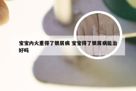 宝宝内火重得了银屑病 宝宝得了银屑病能治好吗