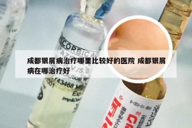 成都银屑病治疗哪里比较好的医院 成都银屑病在哪治疗好