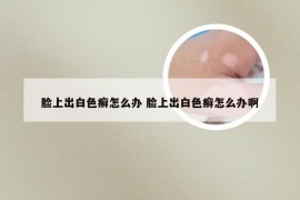 脸上出白色癣怎么办 脸上出白色癣怎么办啊