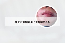 身上不停起癣 身上爱起癣怎么办