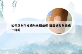 如何区别牛皮癣与鱼鳞病呢 银屑病和鱼鳞病一样吗