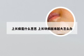 上长癣是什么意思 上长块癣越来越大怎么办