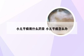 小儿干癣用什么药膏 小儿干癣怎么办