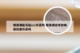 银屑病能引起scc升高吗 银屑病会导致鳞癌抗原升高吗