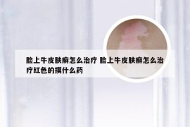 脸上牛皮肤癣怎么治疗 脸上牛皮肤癣怎么治疗红色的摸什么药