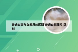 普通白斑与白癜风的区别 普通白斑图片 区别