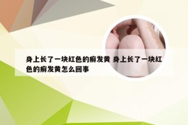 身上长了一块红色的癣发黄 身上长了一块红色的癣发黄怎么回事