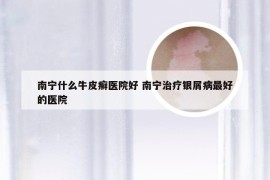 南宁什么牛皮癣医院好 南宁治疗银屑病最好的医院