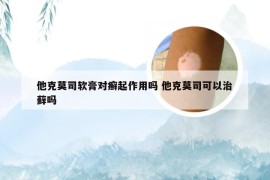 他克莫司软膏对癣起作用吗 他克莫司可以治藓吗