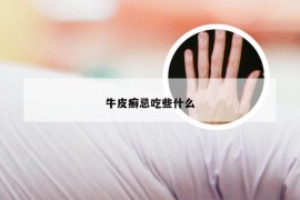 牛皮癣忌吃些什么