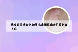 头皮银屑病会全身吗 头皮银屑病会扩散到身上吗