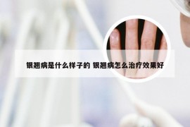 银翘病是什么样子的 银翘病怎么治疗效果好