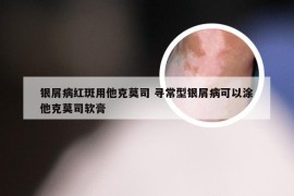 银屑病红斑用他克莫司 寻常型银屑病可以涂他克莫司软膏