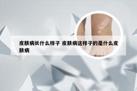 皮肤病长什么样子 皮肤病这样子的是什么皮肤病