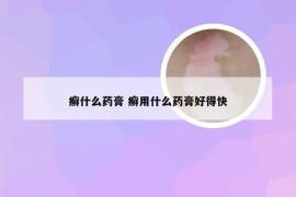 癣什么药膏 癣用什么药膏好得快